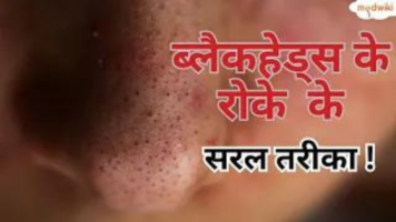 ब्लैकहेड्स के रोके के सरल तरीका !
