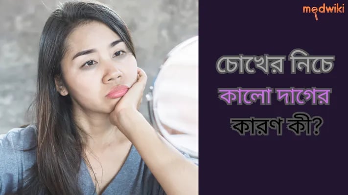 চোখের নিচে কালো দাগের কারণ কী?