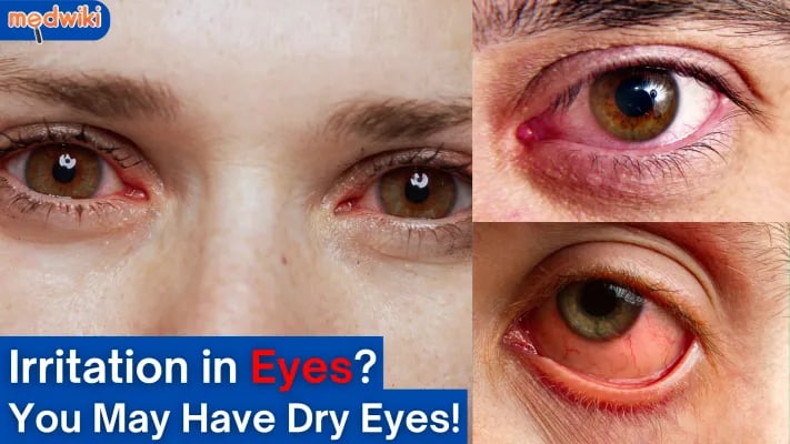 What Causes Dry Eyes All of a Sudden? Causes of Dry and Irritated Eyes! 