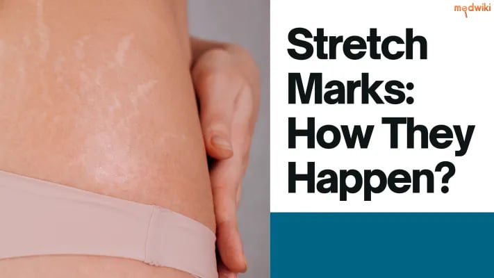 Stretch Marks How They Happen