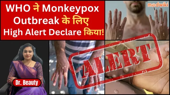 क्या Monkey Pox Virus है Covid से भी ख़तरनाक? | WHO ने किया High Alert जारी | जानिए ख़ौफ़नाक सचाई!