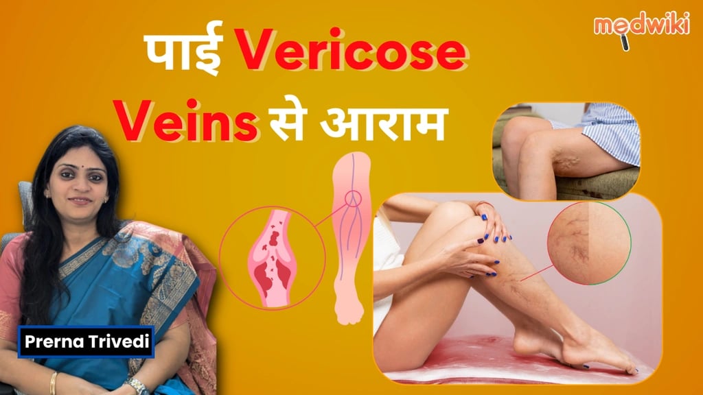 Varicose Veins के प्रबंधन: देखभाल आ चिकित्सा के उपाय!