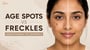 Age Spots vs Freckles: Understanding the Difference!