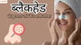 ब्लैकहेड से छुटकारा पावे के प्रभावी तरीका