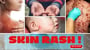 What's Causing Your Skin Rash!