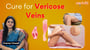 Varicose Veins Treatment | Causes, Symptoms & Self-Care Tips!
