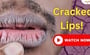Tips for Cracked Lips in Winter!