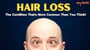 Hair Loss: The Condition That's More Common Than You Think!
