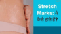 Stretch Marks ये कैसे होते हैं?
