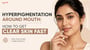 Hyperpigmentation Around Mouth: How to Get Clear Skin Fast!