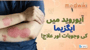 ایگزیما: آ یوروید میں اسباب اور علاج