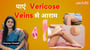 Varicose Veins को मैनेज करें: सेल्फ केयर और मेडिकल उपाय!