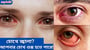 হঠাৎ চোখ শুকিয়ে যাওয়ার কারণ কী? শুষ্ক এবং জ্বালাময় চোখের কারণ