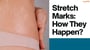 Stretch Marks How They Happen