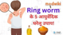 Ringworm के 5 आयुर्वेदिक घरेलू उपाय!