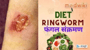 Ringworm में लेवे के डाइट फंगल संक्रमण!