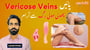 Varicose Veins کو مینیج کریں: سیلف کیئر اور میڈیکل طریقے!