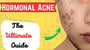 Hormonal Acne: The Ultimate Guide