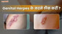 Genital Herpes के इलाज के 6 कारगर तरीका का बा?