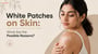 White Patches on Skin: What Are the Possible Reasons?